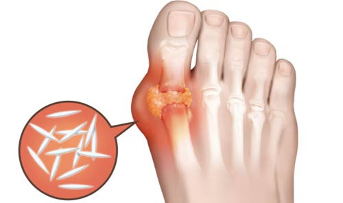 Why is Gout So Painful? The Real Reason Behind the Suffering - Jacksonville - 1