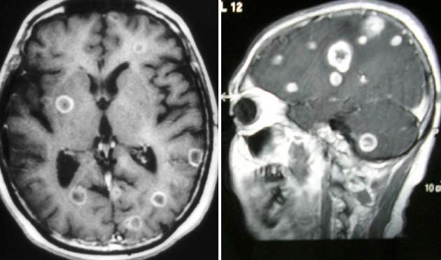 Sudden Discovery of Brain Cancer: Is There a Way to Detect It Early? - Denver - 1
