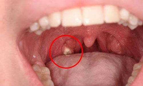 Is There a Foul Smell in Your Mouth? A Story About Tonsil Stones That Won't Go Away Even After Brushing - Burke - 1