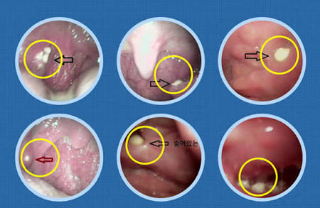 Is There a Foul Smell in Your Mouth? A Story About Tonsil Stones That Won't Go Away Even After Brushing - Burke - 2