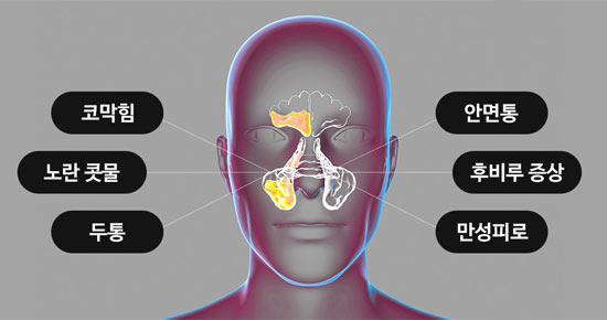 2주 넘게 안 끝나는 콧물, 축농증인지 그냥 후유증인지 구분법 - Los Angeles - 1