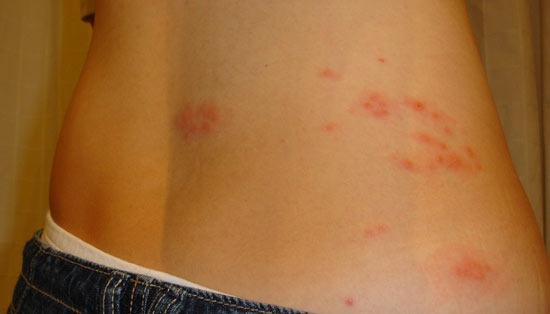 바쁘게 살다가 놓친 신호, 대상포진 골든타임이 중요한 이유 - Pasadena - 1