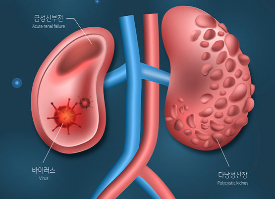 Reasons to Manage Kidney Disease Even When You're Young - Montgomery - 1