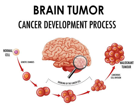 Why is it Difficult to Detect Brain Cancer Early? Signs That Are Easy to Miss - Springfield - 1