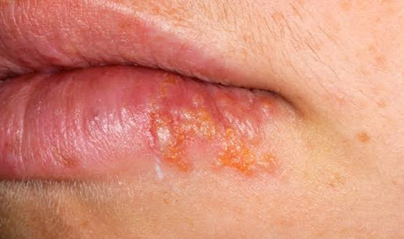 Herpes Simplex Virus: It's Ultimately a Battle of Immunity - Honolulu - 1